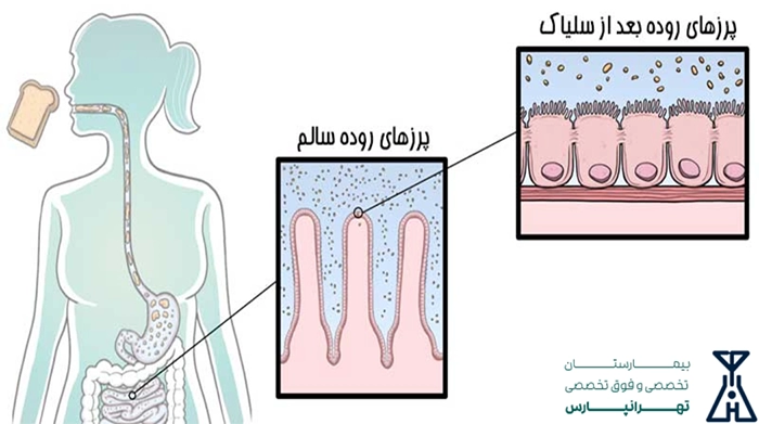 بیماری سلیاک