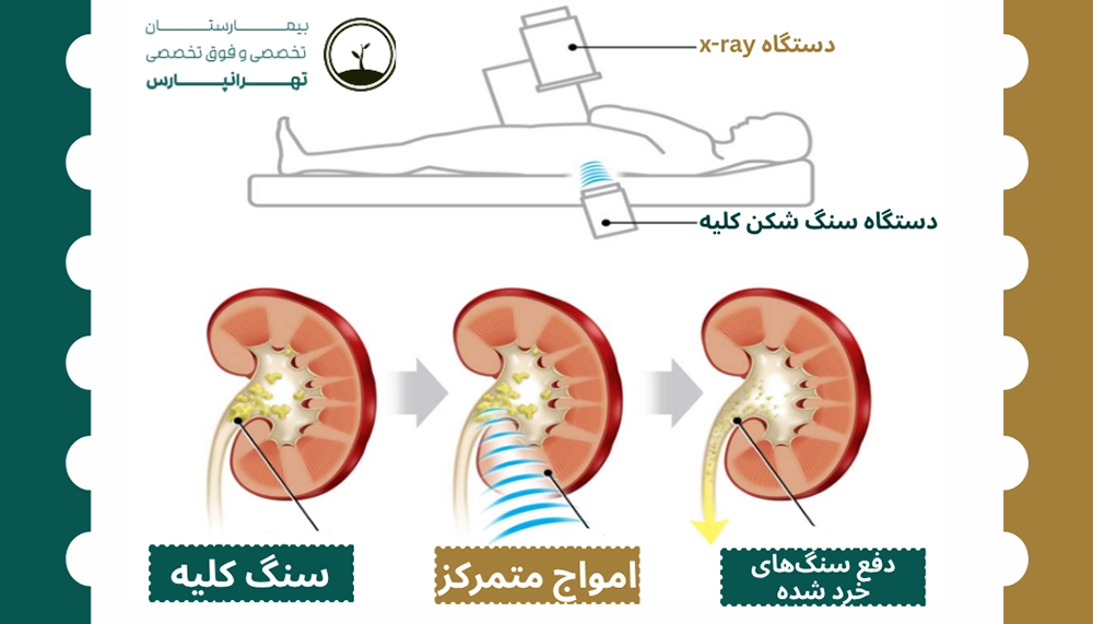 سنگ شکن کلیه