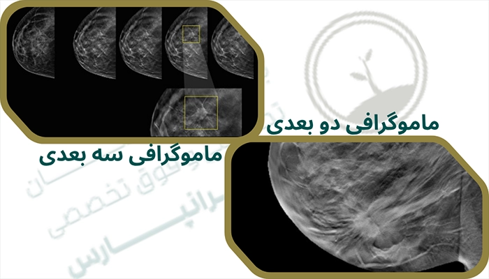 ماموگرافی دو بعدی و سه بعدی