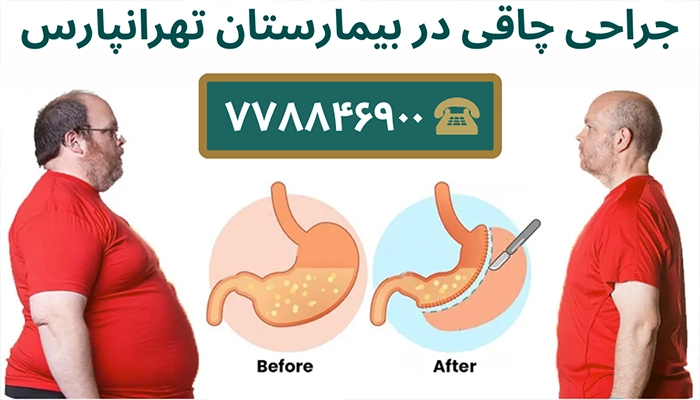 جراحی چاقی بیمارستان تهرانپارس