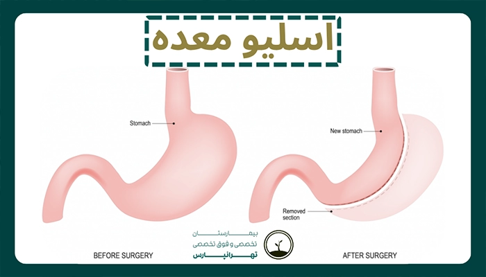 اسلیو معده در بیمارستان تهرانپارس