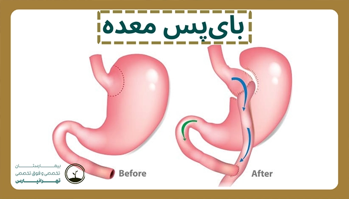 بای پس معده بیمارستان تهرانپارس