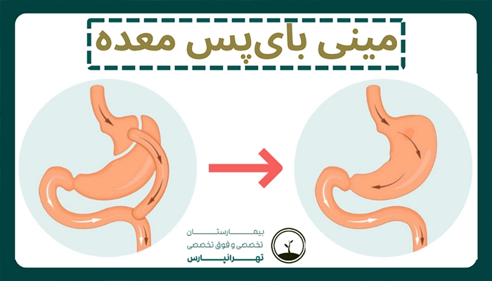 مینی بای پس معده