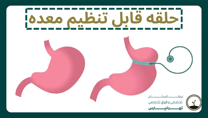 جراحی حلقه قابل تنظیم معده