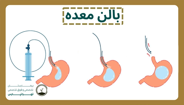 بالن معده در بیمارستان تهرانپارس