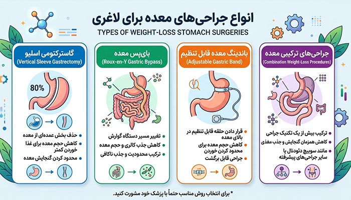 انواع جراحی‌های معده برای لاغری