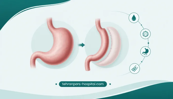 عوارض و خطرات احتمالی عمل اسلیو معده — نمای شماتیک کاهش حجم معده در جراحی اسلیو و محل بخیهها